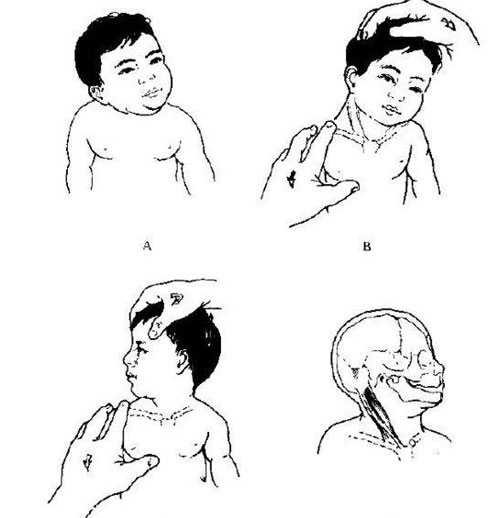小儿斜颈俗称歪脖子的治疗