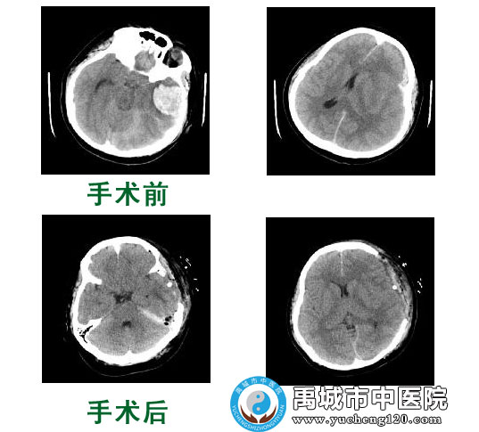 脑出血脑疝病人手术前后颅脑CT影像图对比
