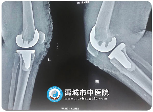 患者双膝关节退变，间隙狭窄，骨质增生明显，软骨下硬化严重，中度X腿畸形