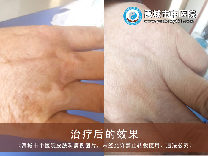 禹城市中医院皮肤科临床治好白癜风患者一例
