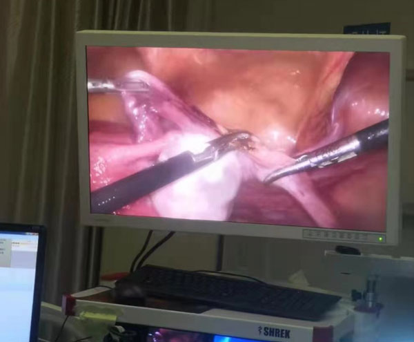 腹腔镜下全子宫及双侧附件切除术